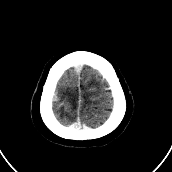 File:Cerebral venous hemorrhagic infarct from venous sinus thrombosis (Radiopaedia 55433-61883 Axial C+ delayed 19).jpg