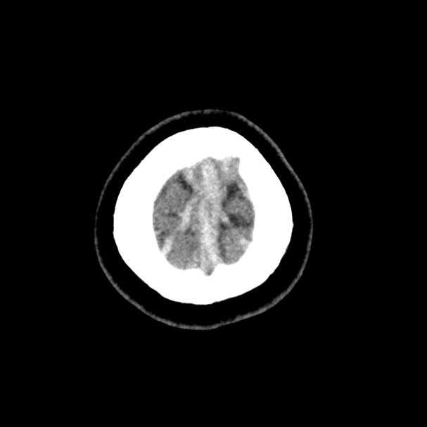 Cerebral venous sinus thrombosis (Radiopaedia 59224-66551 Axial non-contrast 58).jpg