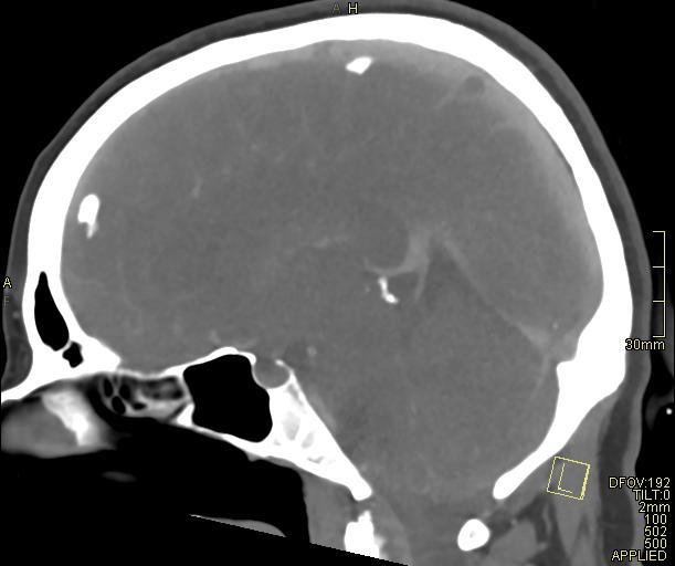 Cerebral venous sinus thrombosis (Radiopaedia 91329-108965 Sagittal venogram 38).jpg
