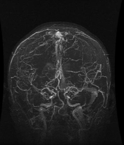 File:Cerebral venous thrombosis (Radiopaedia 11289-11653 E 1).jpg