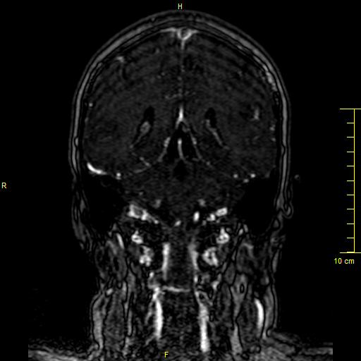 File:Cerebral venous thrombosis (Radiopaedia 23288-23351 MRV 105).JPG
