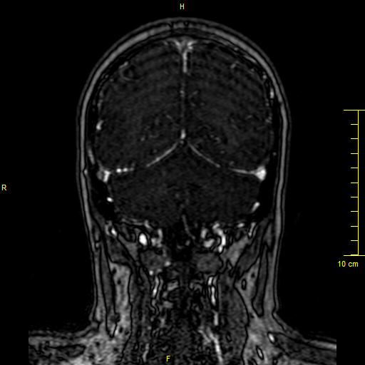 File:Cerebral venous thrombosis (Radiopaedia 23288-23351 MRV 125).JPG
