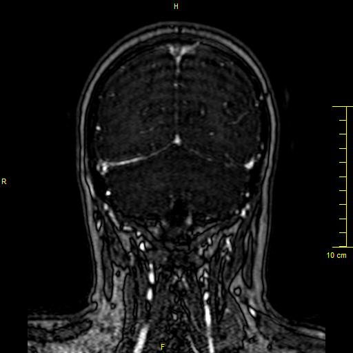 Cerebral venous thrombosis (Radiopaedia 23288-23351 MRV 133).JPG