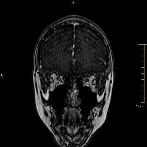Cerebral venous thrombosis (Radiopaedia 23288-23351 MRV 14).JPG