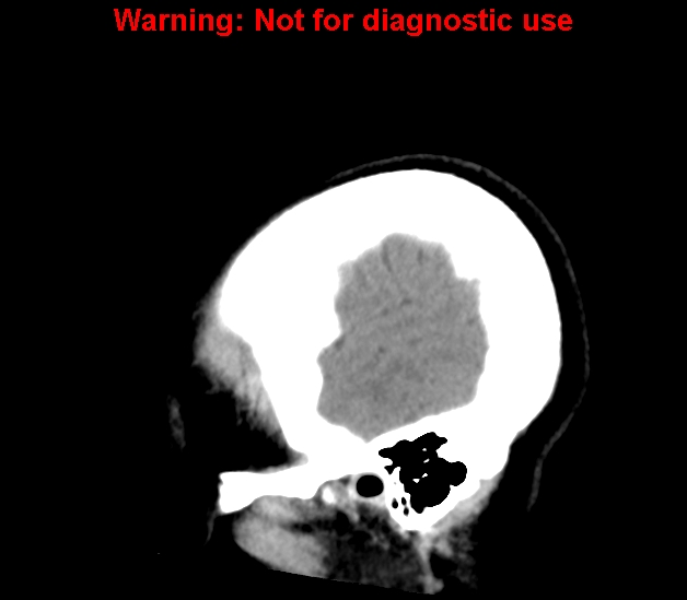 File:Cerebral venous thrombosis (Radiopaedia 37224-38992 B 4).jpg