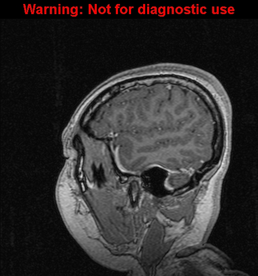 Cerebral venous thrombosis (Radiopaedia 37224-39208 Sagittal T1 C+ 27).jpg