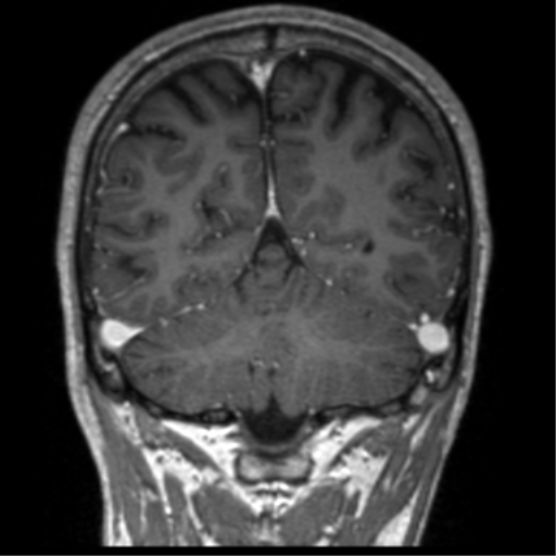 Cerebral venous thrombosis (Radiopaedia 38392-40469 Coronal T1 C+ 24).png