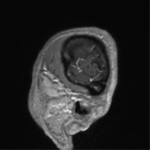 Cerebral venous thrombosis (Radiopaedia 38392-40469 Sagittal T1 C+ 80).png
