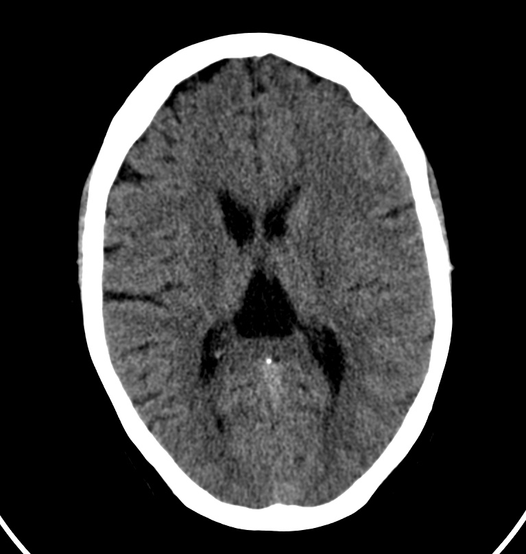Cerebral venous thrombosis - CT only (Radiopaedia 41031-43778 Axial non-contrast 37).jpg