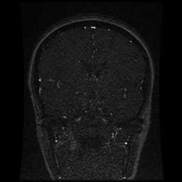 Cerebral venous thrombosis - ulcerative colitis (Radiopaedia 66049-75219 Coronal MRV 67).jpg
