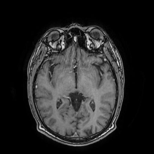 File:Cerebral venous thrombosis with secondary intracranial hypertension (Radiopaedia 89842-106957 Axial T1 C+ 90).jpg