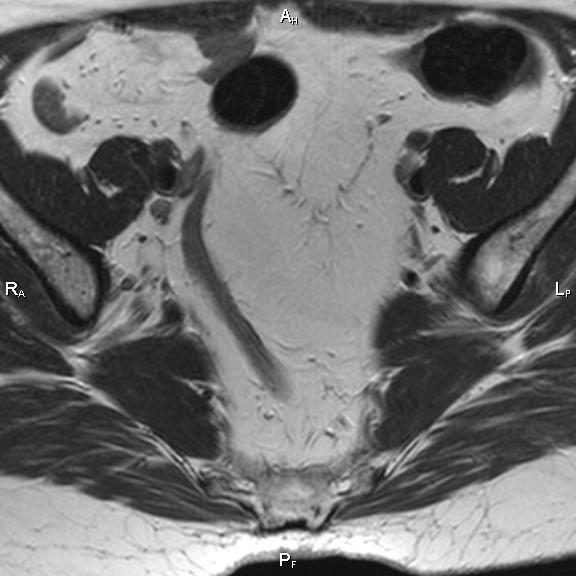 File:Cervical adenocarcinoma (Radiopaedia 65011-73985 Axial T2 29).jpg