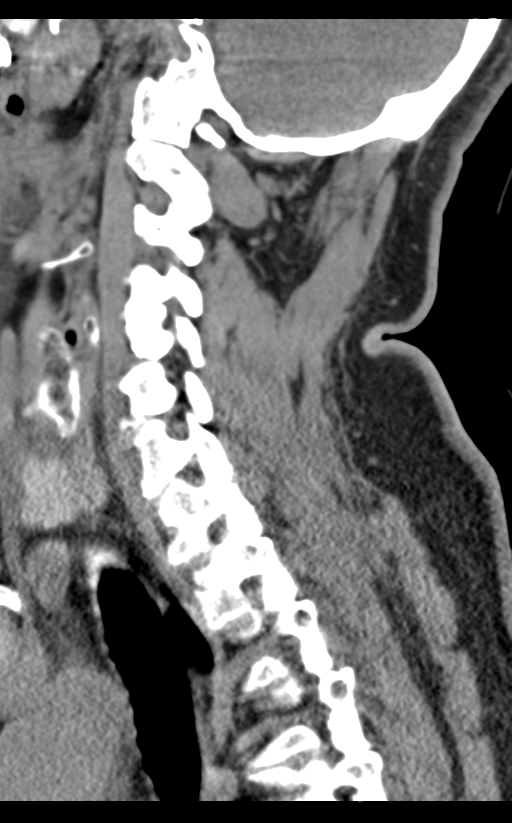 Cervical canal stenosis - OPLL and osteophytes (Radiopaedia 47329-51910 B 51).png