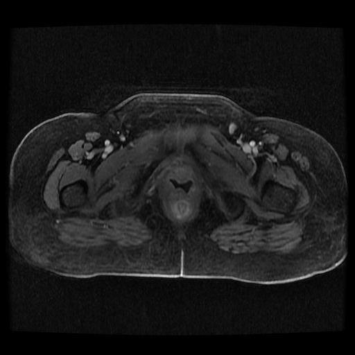 Cervical carcinoma (Radiopaedia 70924-81132 Axial T1 C+ fat sat 200).jpg