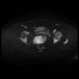 Cervical carcinoma (Radiopaedia 88010-104555 Axial DWI 69).jpg
