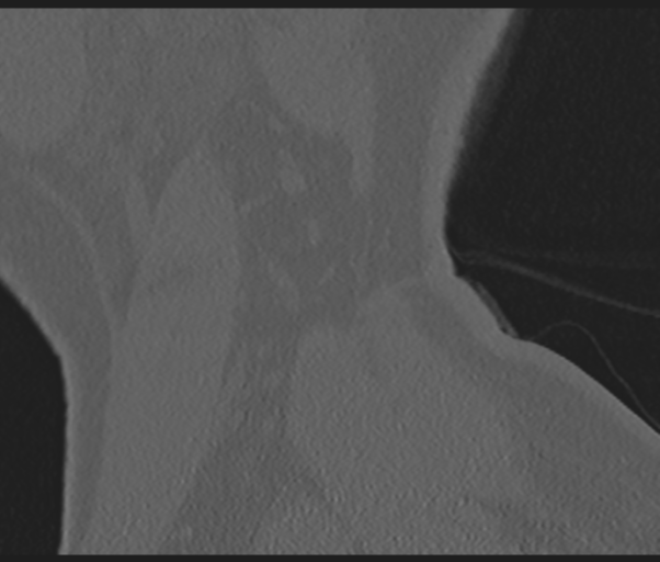 Cervical disc replacement (Radiopaedia 44025-47541 Sagittal bone window 4).png