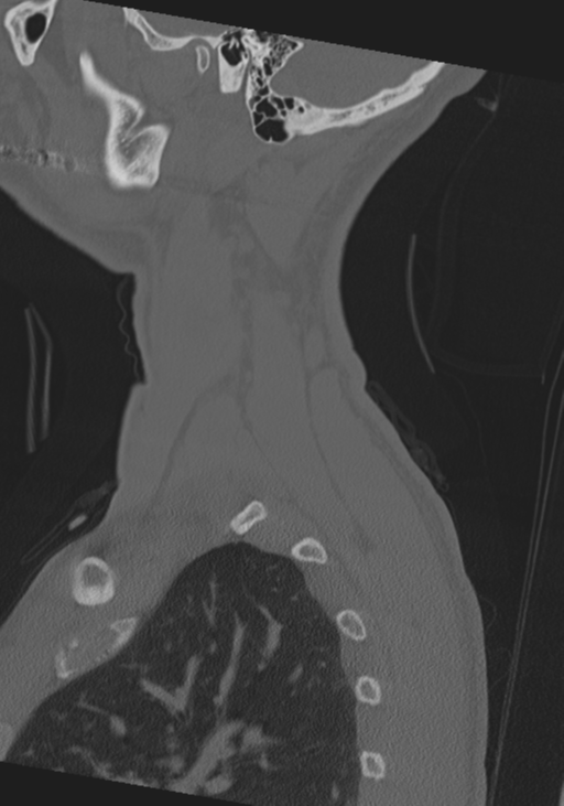 Cervical intercalary bone (Radiopaedia 35211-36748 Sagittal bone window 74).png