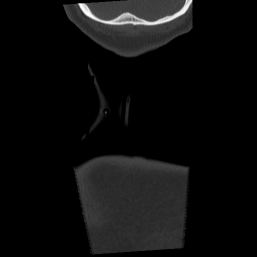 Cervical schwannoma (Radiopaedia 57979-64974 Coronal bone window 67).png
