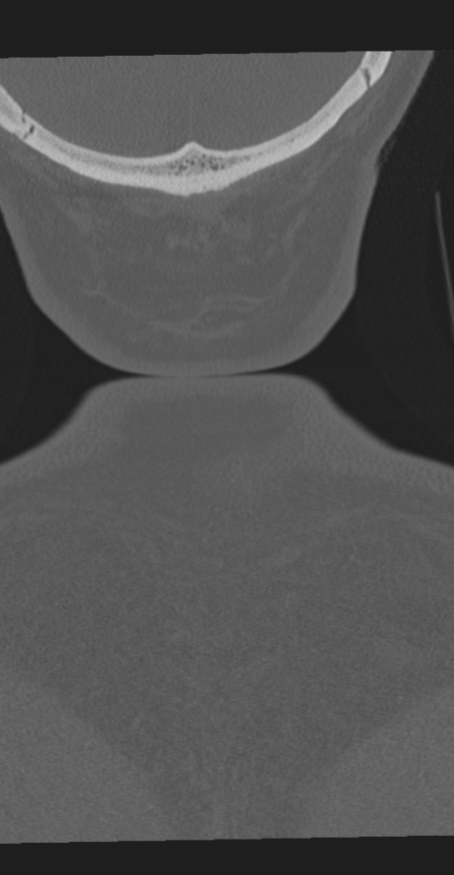 Cervical spine fracture in the setting of ankylosis (Radiopaedia 37038-38715 Coronal bone window 80).png