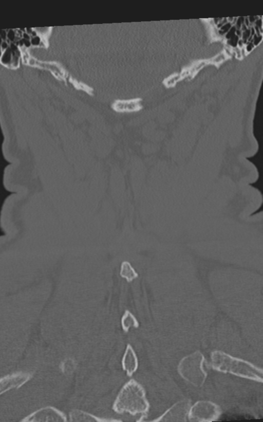 Cervical spine fractures with vertebral artery dissection (Radiopaedia 53296-59268 Coronal bone window 58).png