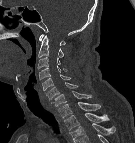 File:Cervical spine trauma with tear drop fracture and perched facet joint (Radiopaedia 53989-60127 Sagittal bone window 78).jpg
