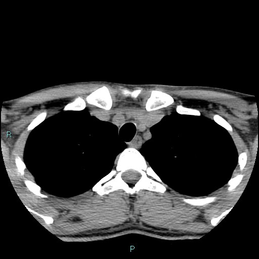Cervical thymic cyst (Radiopaedia 88632-105335 Axial non-contrast 16).jpg