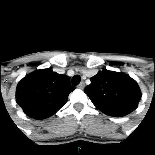 Cervical thymic cyst (Radiopaedia 88632-105335 C 16).jpg