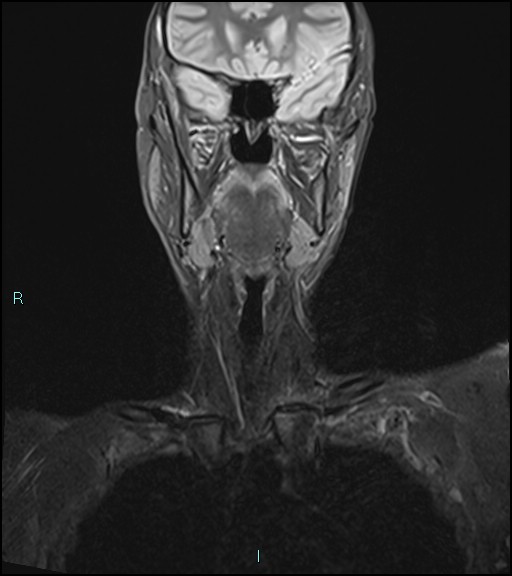 File:Cervical thymic cyst (Radiopaedia 88632-105336 Coronal STIR 18).jpg
