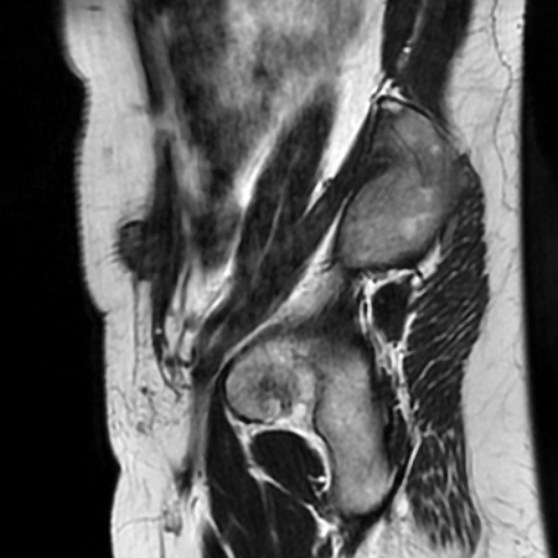File:Cesarian section scar endometriosis (Radiopaedia 66520-75799 Sagittal T2 13).jpg