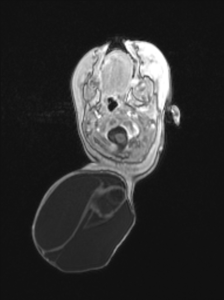 Chiari III malformation with occipital encephalocele (Radiopaedia 79446-92559 Axial T1 C+ mpr 27).jpg