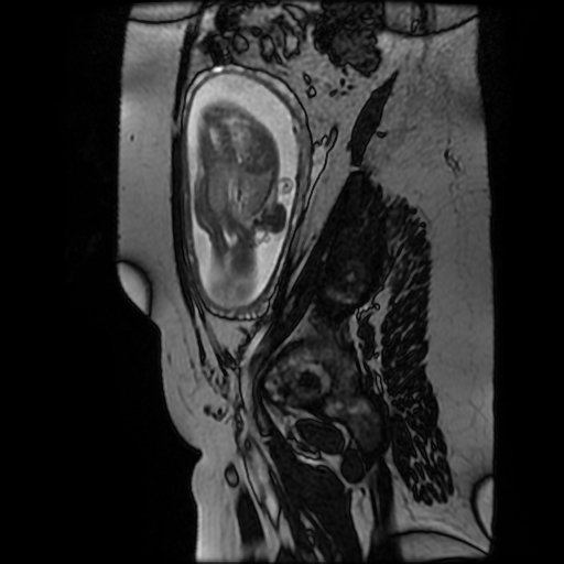 Chiari II malformation - fetal MRI (Radiopaedia 68099-77581 Sagittal Fiesta 13).jpg