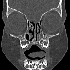Choanal atresia (Radiopaedia 88525-105975 Coronal bone window 15).jpg