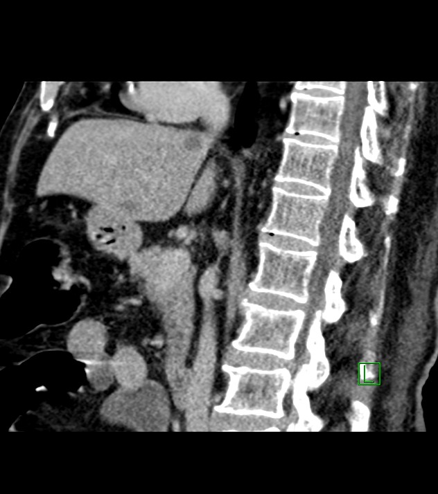 Cholangiocarcinoma with cerebral metastases (Radiopaedia 83519-98629 Sagittal C+ delayed 59).jpg