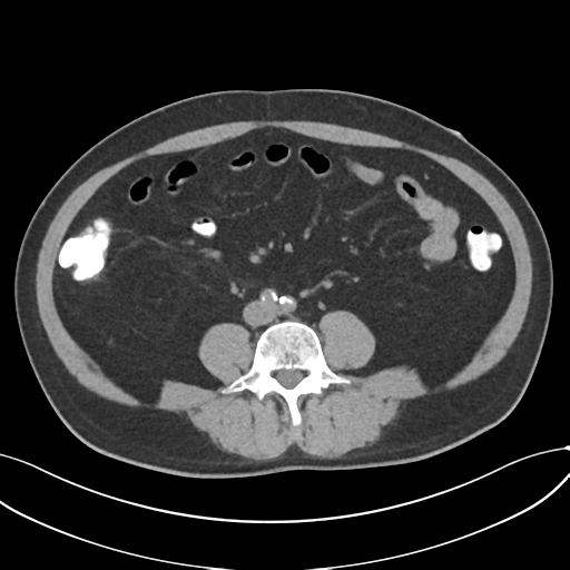 File:Cholecystitis with focal perforation and hepatic abscess (Radiopaedia 37189-38945 Axial non-contrast 50).png
