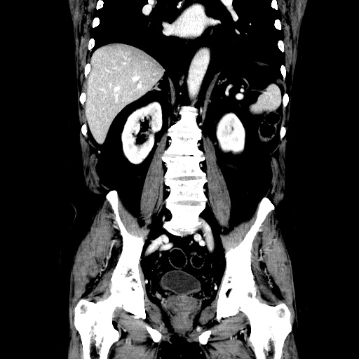 Choledocholiathiasis with normal caliber common bile duct (Radiopaedia 75368-86632 Coronal liver window 80).jpg