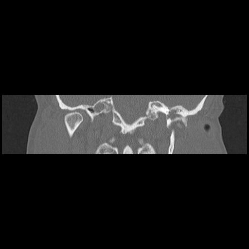 Cholesteatoma (Radiopaedia 84946-100455 Coronal bone window 91).jpg