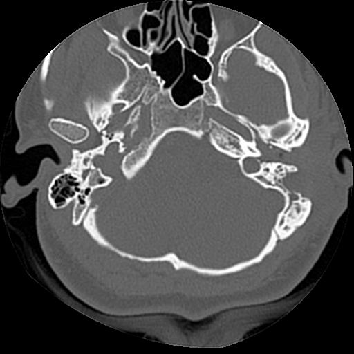 Cholesteatoma (Radiopaedia 84960-100474 Axial bone window 50).jpg