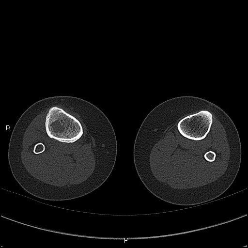 File:Chondroblastoma (Radiopaedia 62721-71030 Axial bone window 96).jpg