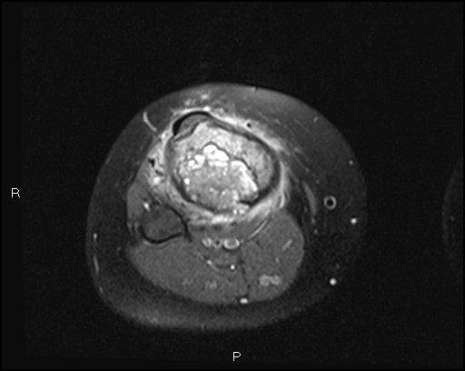 File:Chondroblastoma (Radiopaedia 62721-71031 Axial PD fat sat 27).jpg