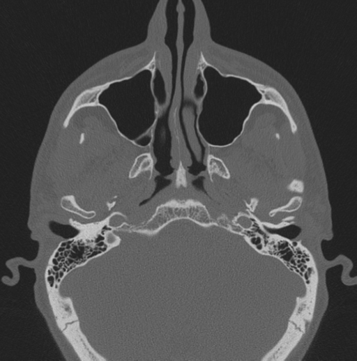 Chondrosarcoma (clivus) (Radiopaedia 46895-51425 Axial bone window 56).png