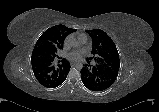 Chondrosarcoma - chest wall (Radiopaedia 65192-74199 Axial bone window 59).jpg