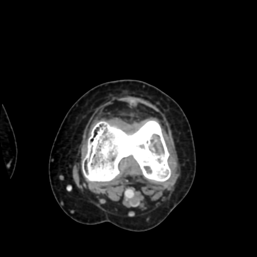 Chondrosarcoma - femur (Radiopaedia 64187-72954 Axial with contrast 52).jpg