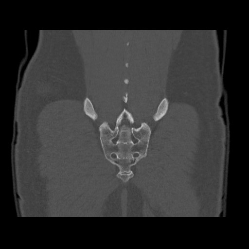Chondrosarcoma of iliac wing (Radiopaedia 63861-72599 Coronal bone window 100).jpg