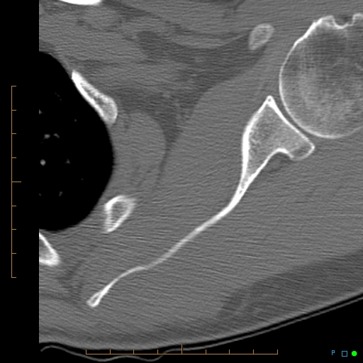 File:Chondrosarcoma of the scapula (Radiopaedia 30696-31399 Axial non-contrast 1).jpg