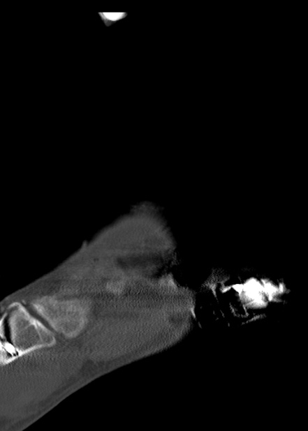 Chopart fracture (Radiopaedia 35347-36861 Sagittal bone window 25).jpg