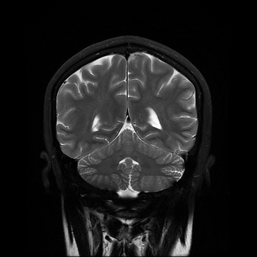 File:Chordoid glioma of third ventricle (Radiopaedia 91612-109340 Coronal T2 23).jpg