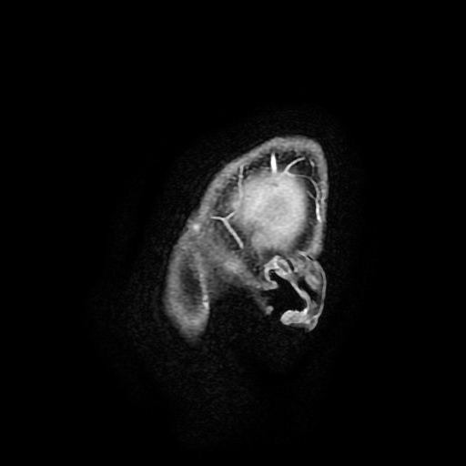 Chordoid glioma of third ventricle (Radiopaedia 91612-109340 F 13).jpg