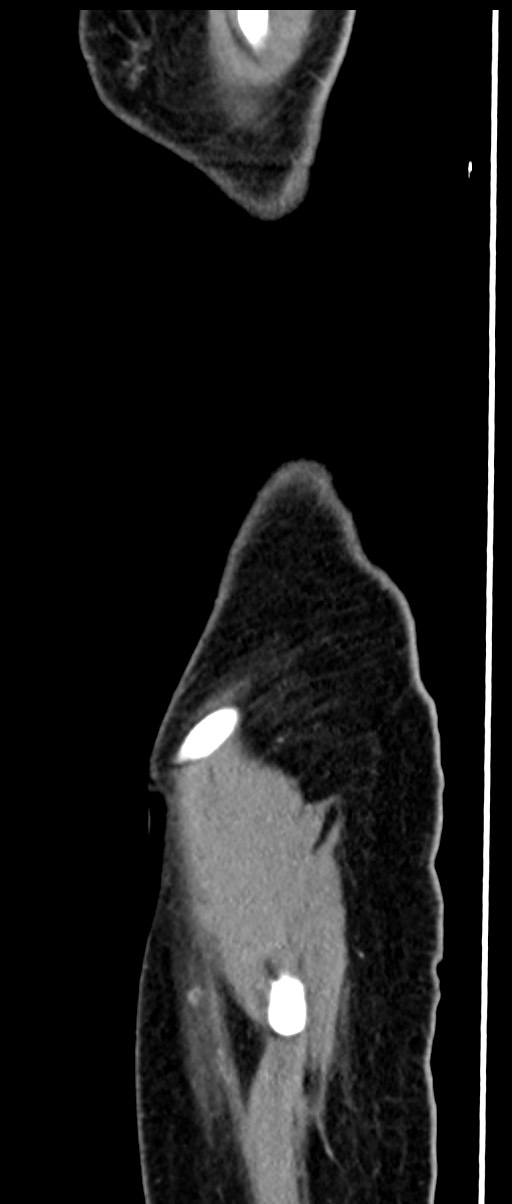 Choriocarcinoma liver metastases (Radiopaedia 74768-85766 C 33).jpg