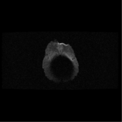 Choroid plexus papilloma (Radiopaedia 34951-36441 Axial DWI 14).png