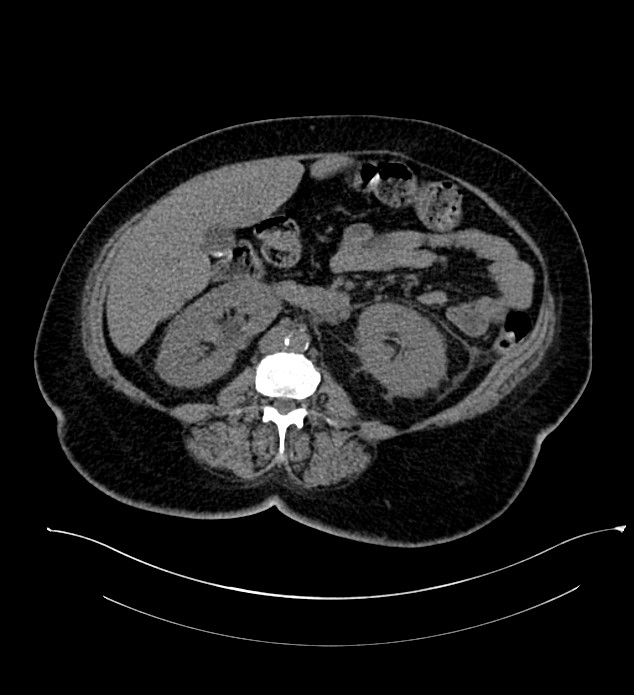 Chromophobe renal cell carcinoma (Radiopaedia 84239-99519 Axial non-contrast 85).jpg